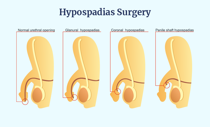Hypospadias: The Art and the Artist