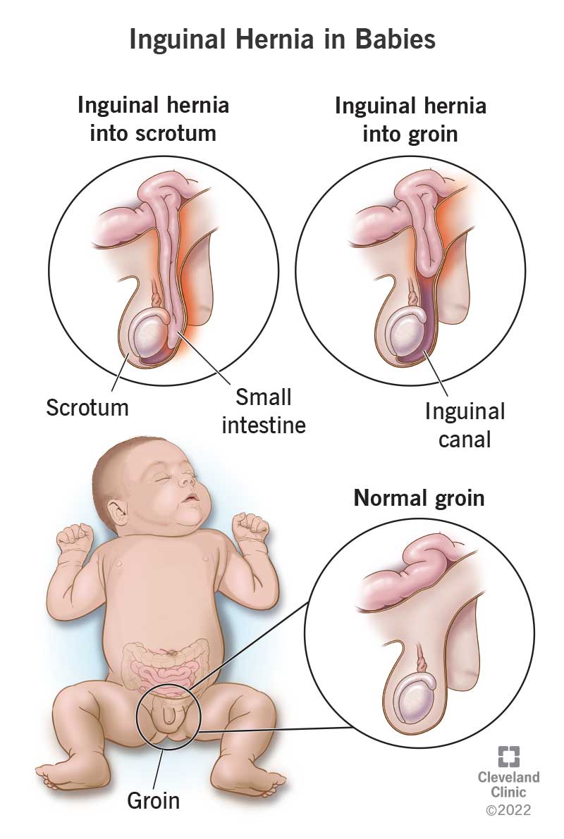 Pediatric Inguinal Hernia: Myths vs. Facts